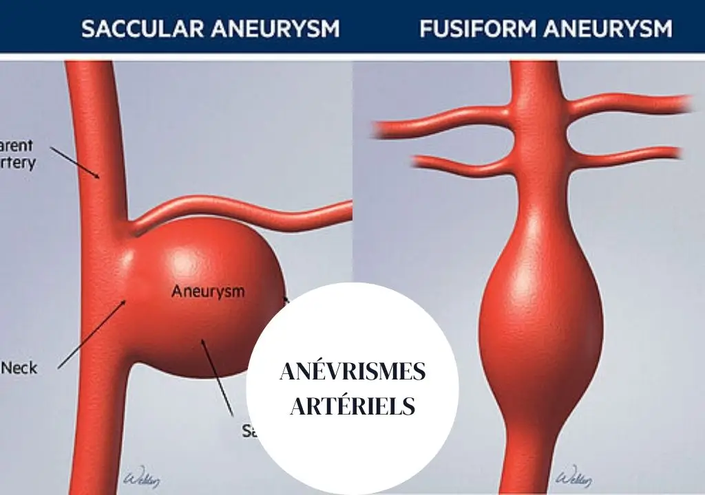 anévrismes artériels