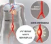 anévrisme aorte abdominale
