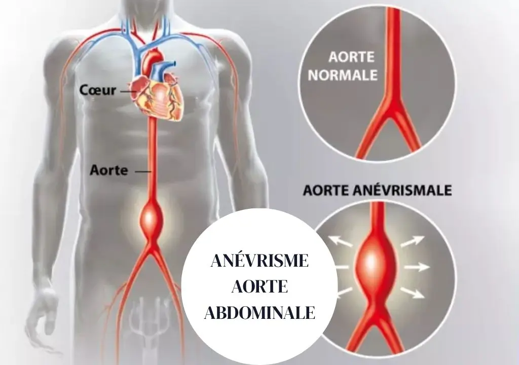 anévrisme aorte abdominale