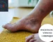 Insuffisance veineuse chronique