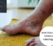 Insuffisance veineuse chronique