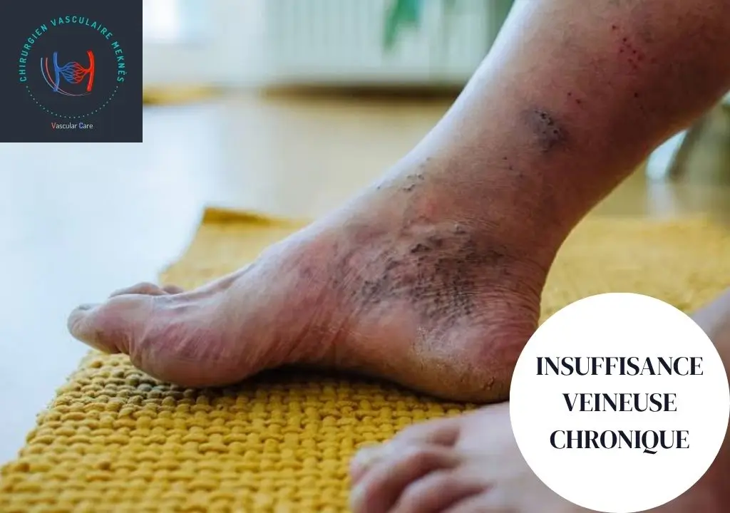 Insuffisance veineuse chronique